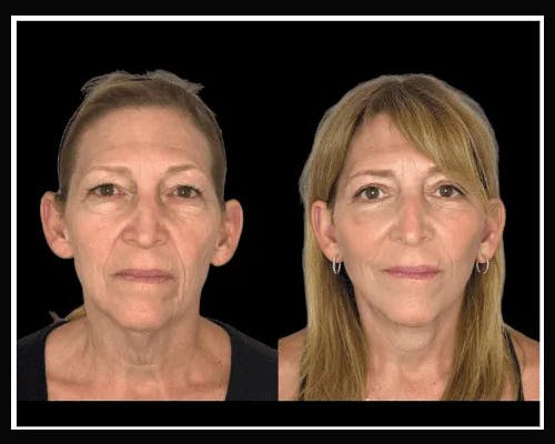 Deep Plane Facelift Before & After Gallery - Patient 138212 - Image 4
