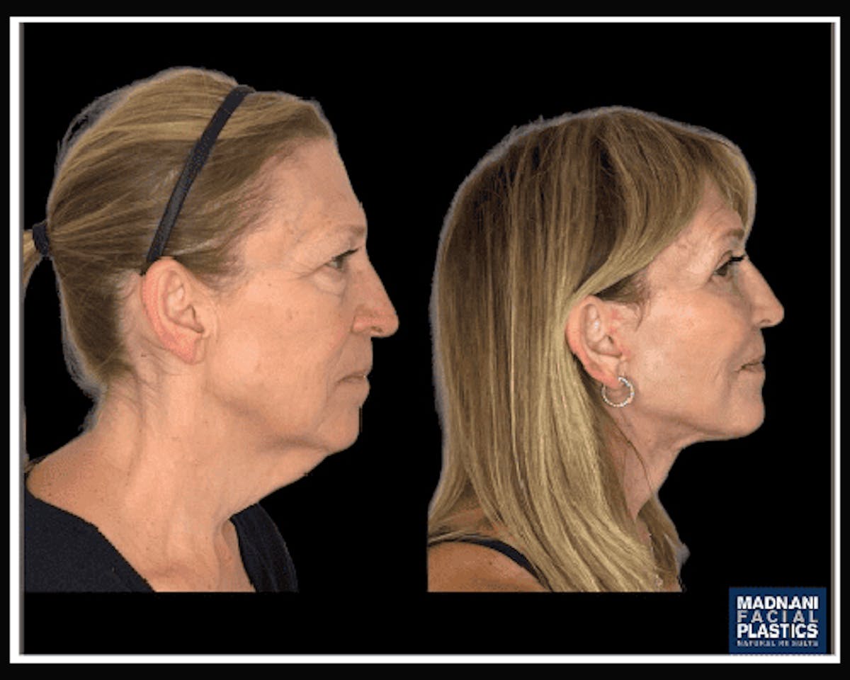 Deep Plane Facelift Before & After Gallery - Patient 138212 - Image 5