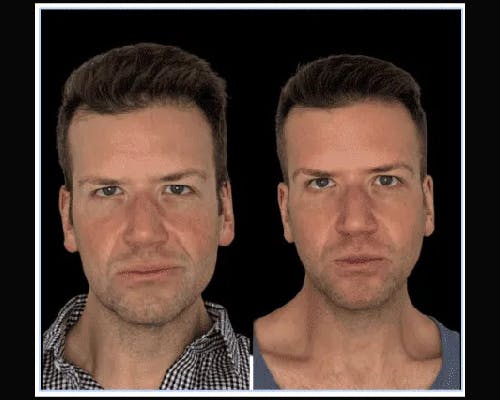 Deep Plane Facelift Before & After Gallery - Patient 425663 - Image 1