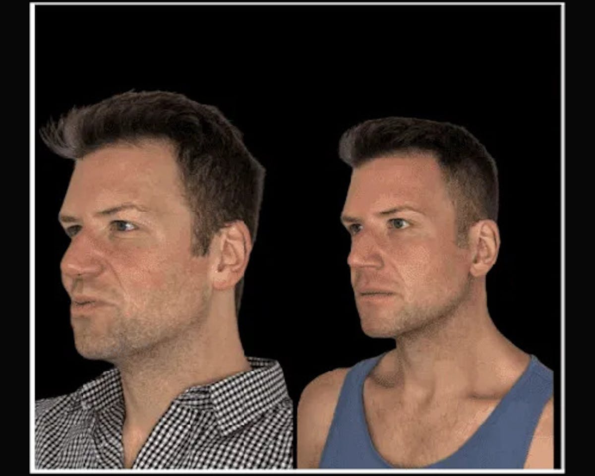 Deep Plane Facelift Before & After Gallery - Patient 425663 - Image 2