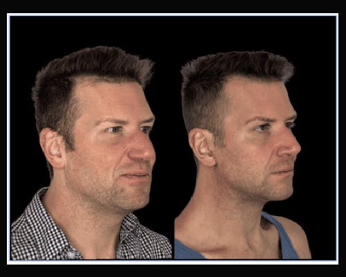 Deep Plane Facelift Before & After Gallery - Patient 425663 - Image 3