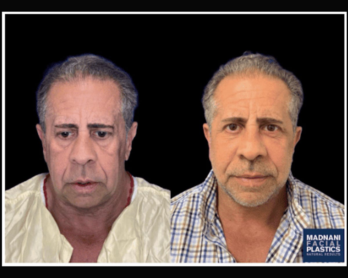 Male Facelift Before & After Gallery - Patient 103725 - Image 1