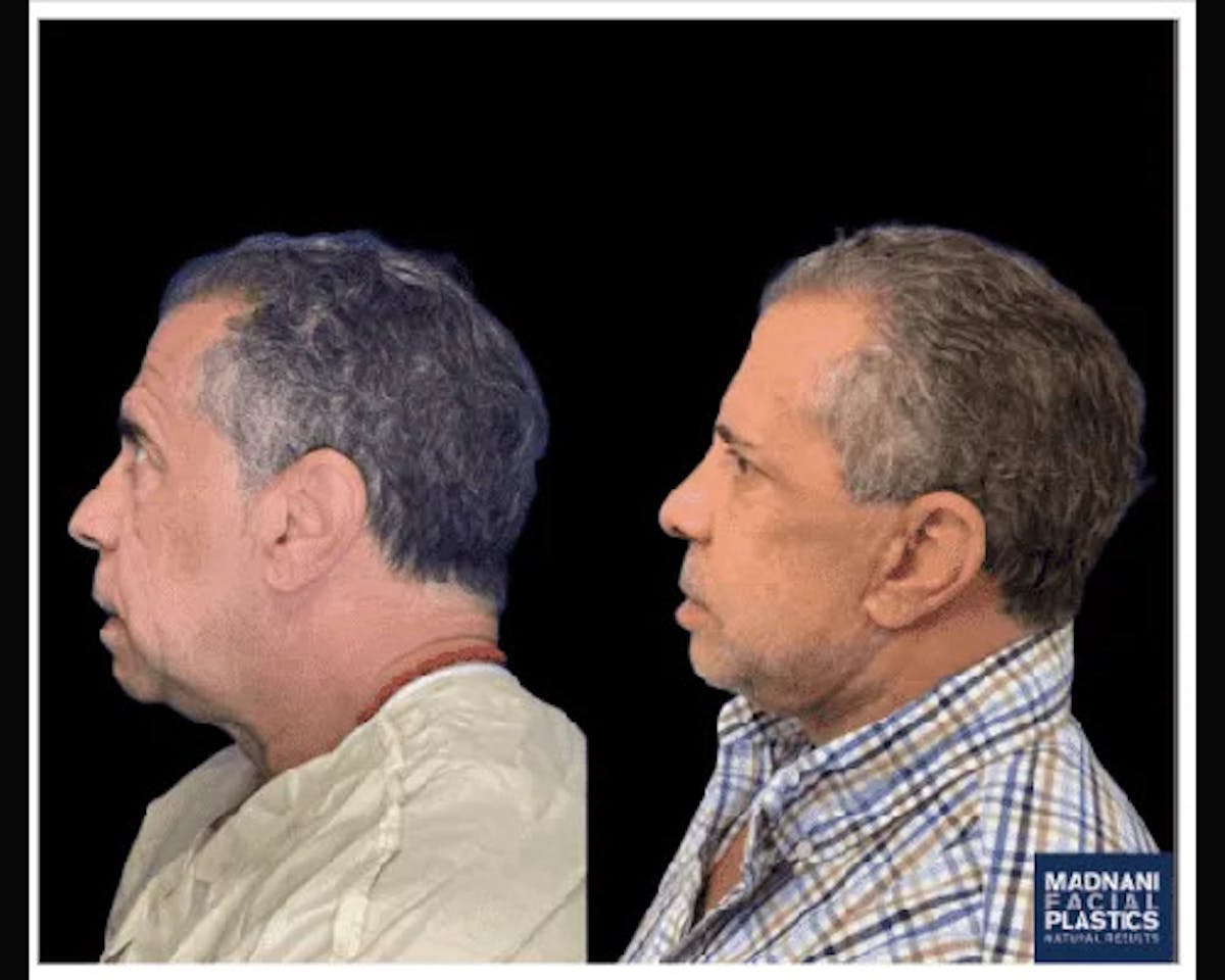 Male Facelift Before & After Gallery - Patient 103725 - Image 2
