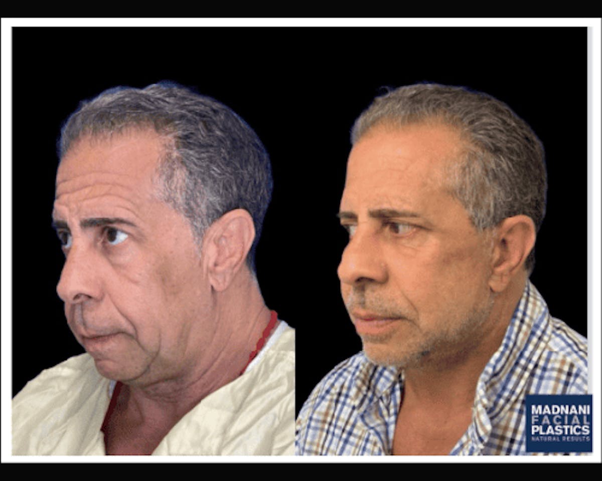 Male Facelift Before & After Gallery - Patient 103725 - Image 3