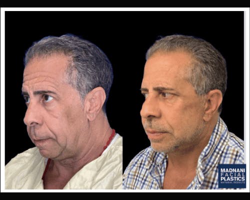 Male Facelift Before & After Gallery - Patient 103725 - Image 3