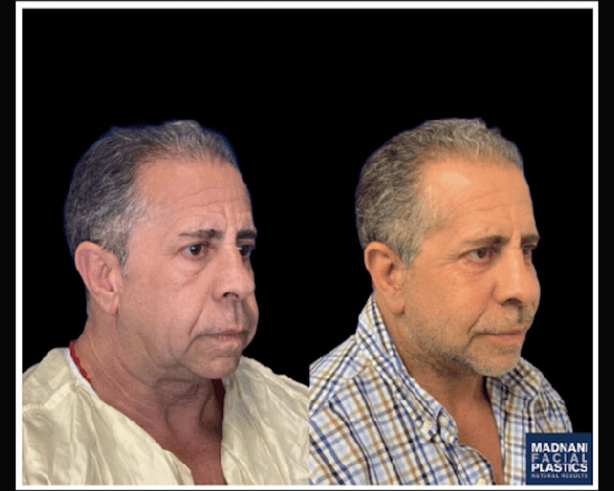 Male Facelift Before & After Gallery - Patient 103725 - Image 4