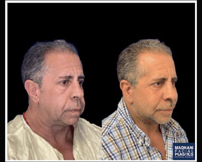 Deep Plane Facelift Before & After Gallery - Patient 258231 - Image 4