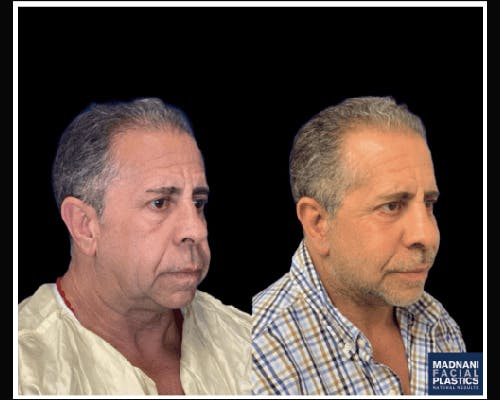 Male Facelift Before & After Gallery - Patient 103725 - Image 4