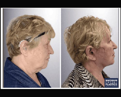 Deep Plane Facelift Before & After Gallery - Patient 426543 - Image 1
