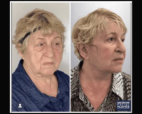 Deep Plane Facelift Before & After Gallery - Patient 426543 - Image 2