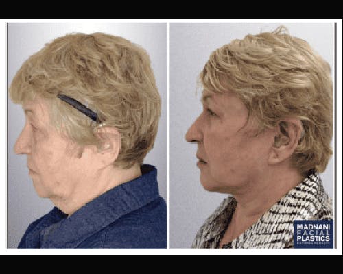 Deep Plane Facelift Before & After Gallery - Patient 426543 - Image 3