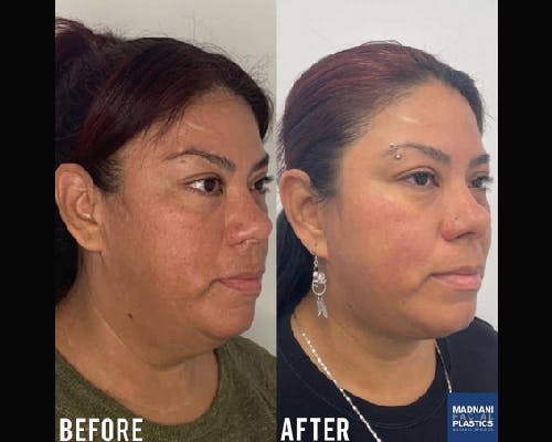 Ethnic Facelift Before & After Gallery - Patient 363153 - Image 1