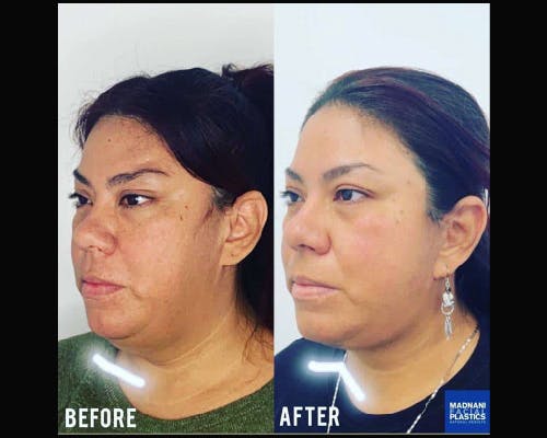 Ethnic Facelift Before & After Gallery - Patient 363153 - Image 2