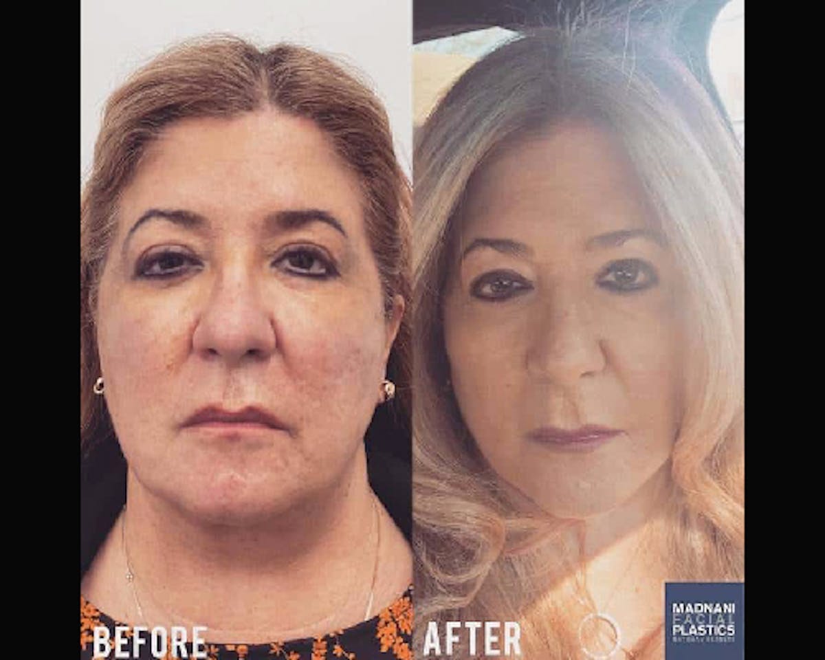 Deep Plane Facelift Before & After Gallery - Patient 405400 - Image 1