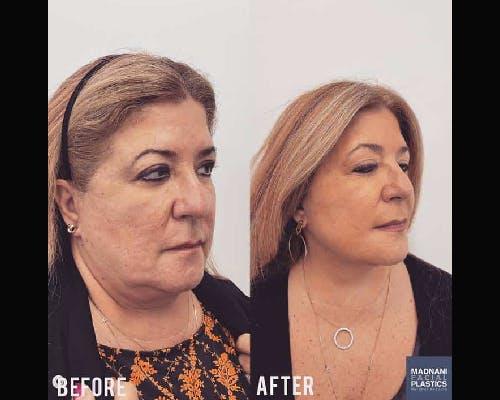 Ethnic Facelift Before & After Gallery - Patient 279321 - Image 2