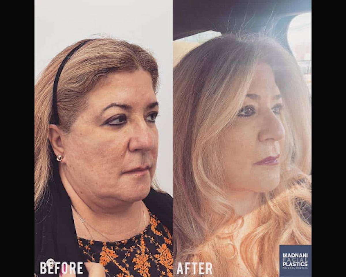 Deep Plane Facelift Before & After Gallery - Patient 405400 - Image 3