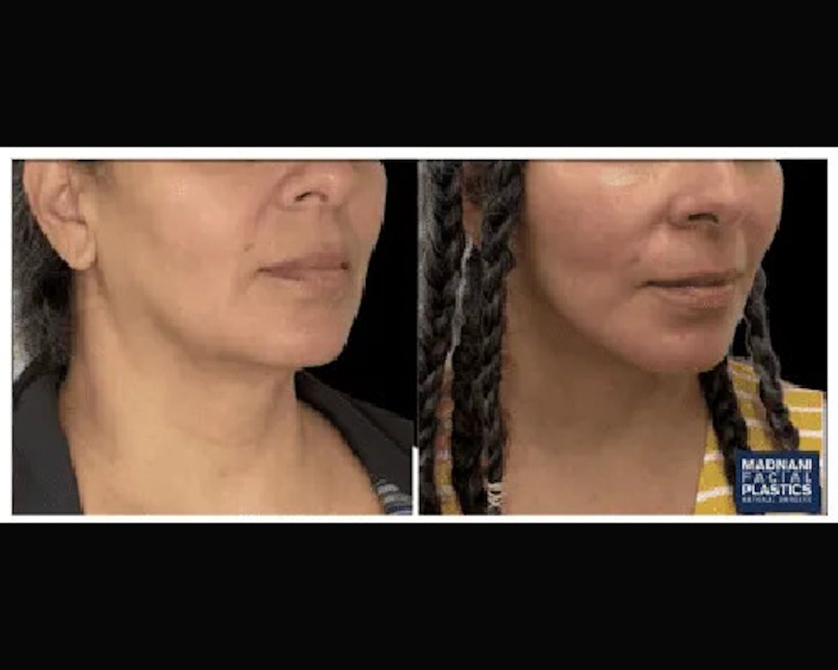 Deep Plane Facelift Before & After Gallery - Patient 428006 - Image 1
