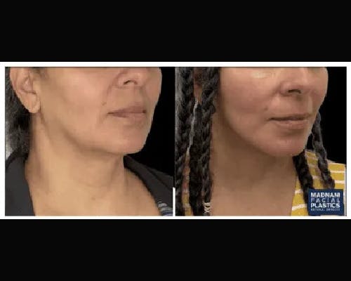 Ethnic Facelift Before & After Gallery - Patient 380443 - Image 1