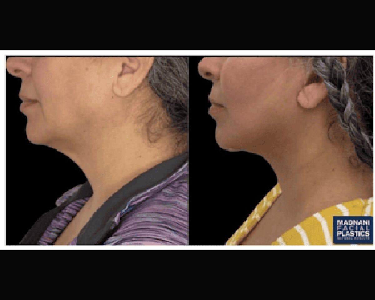 Deep Plane Facelift Before & After Gallery - Patient 428006 - Image 2