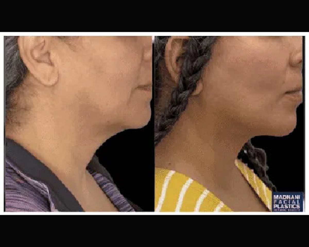 Deep Plane Facelift Before & After Gallery - Patient 428006 - Image 3