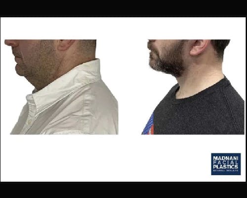 Deep Plane Facelift Before & After Gallery - Patient 252535 - Image 1