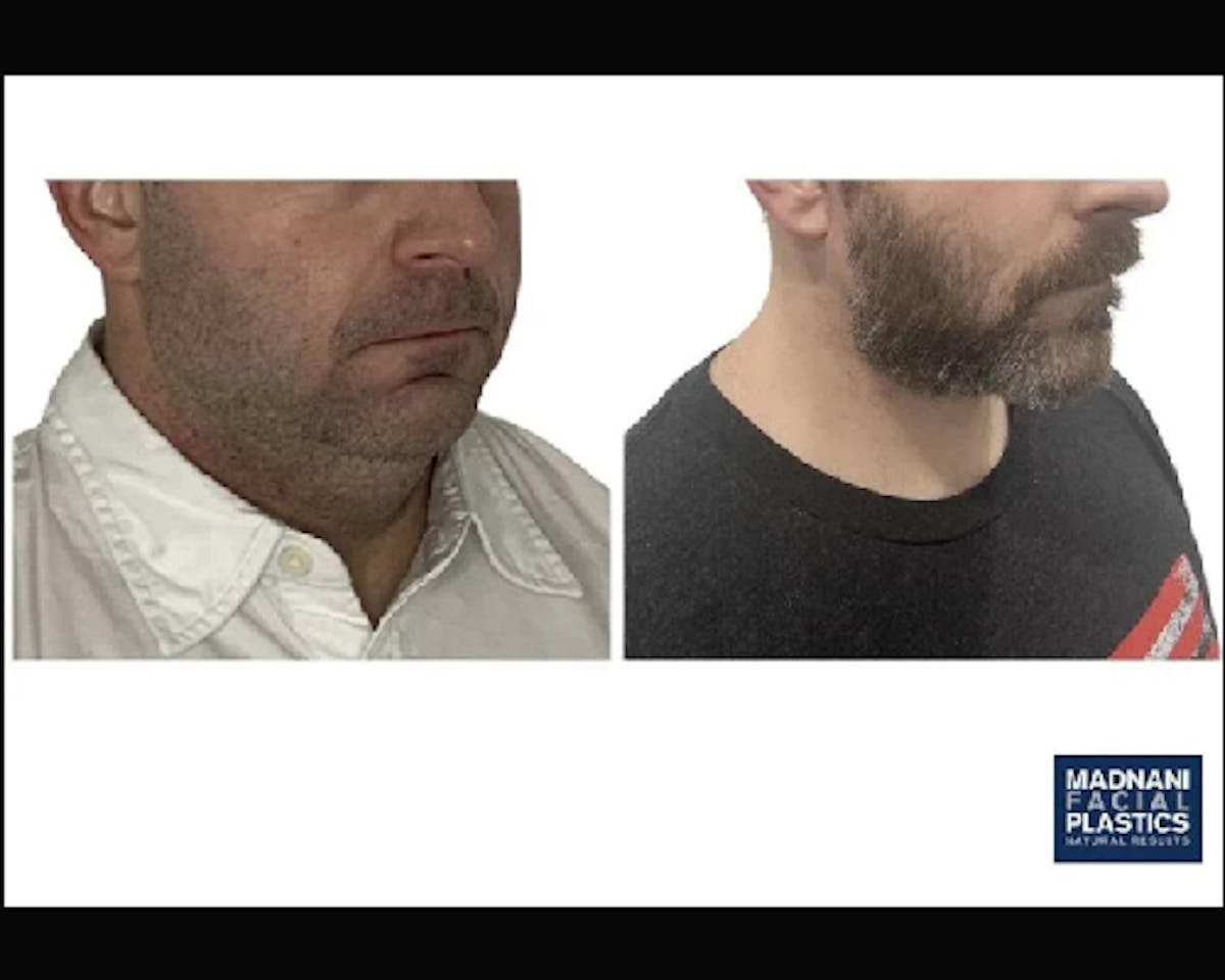 Deep Plane Facelift Before & After Gallery - Patient 252535 - Image 2