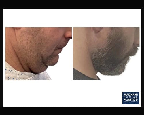 Deep Plane Facelift Before & After Gallery - Patient 252535 - Image 3