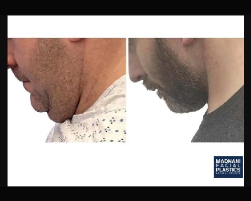 Deep Plane Facelift Before & After Gallery - Patient 252535 - Image 4