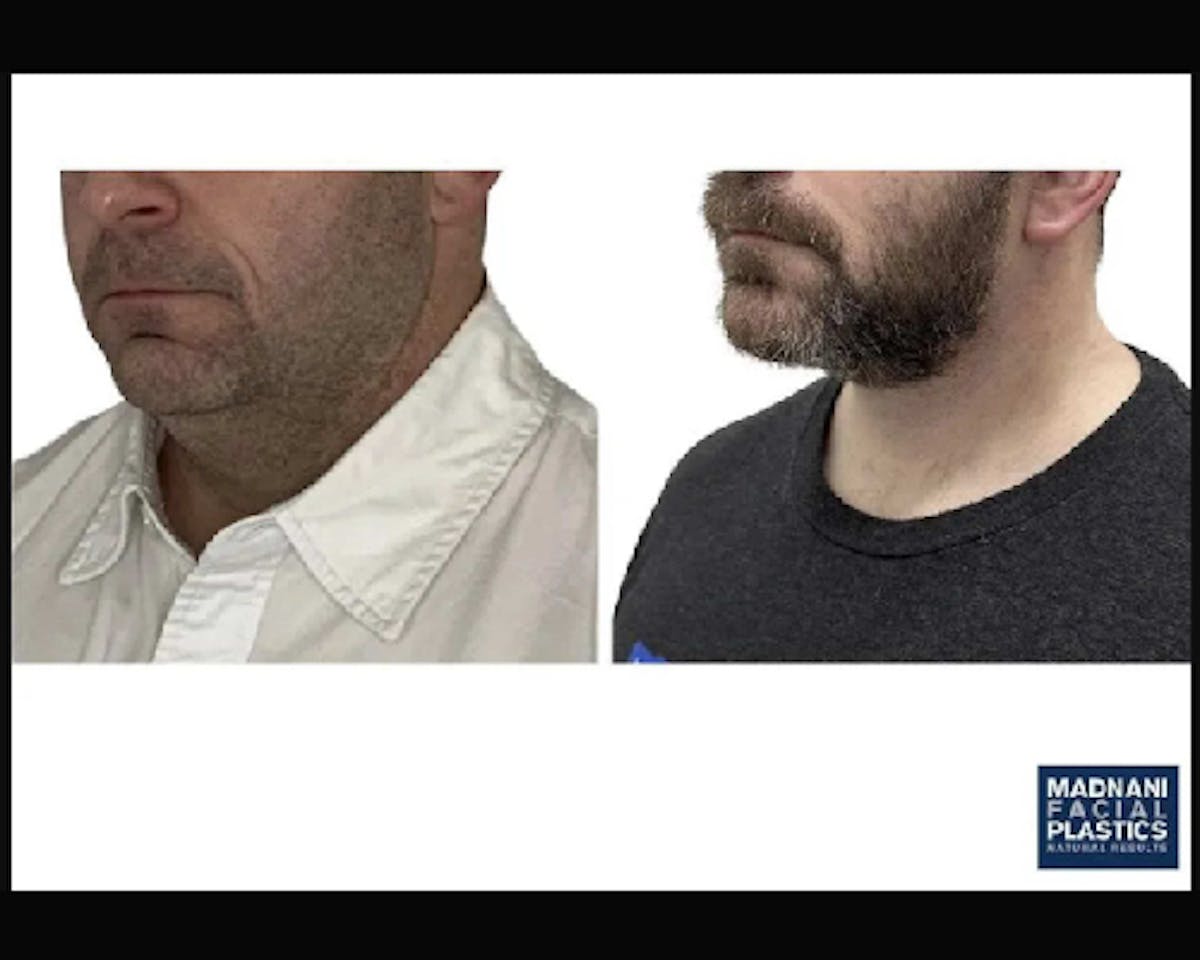 Deep Plane Facelift Before & After Gallery - Patient 252535 - Image 5