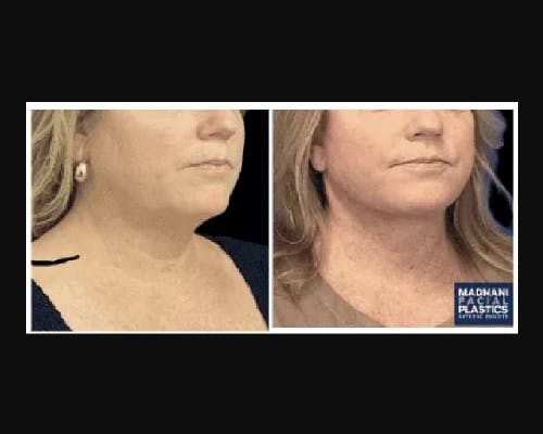 Deep Plane Facelift Before & After Gallery - Patient 268863 - Image 1