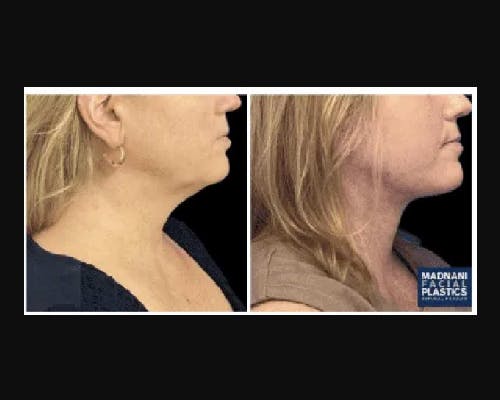 Deep Plane Facelift Before & After Gallery - Patient 268863 - Image 2