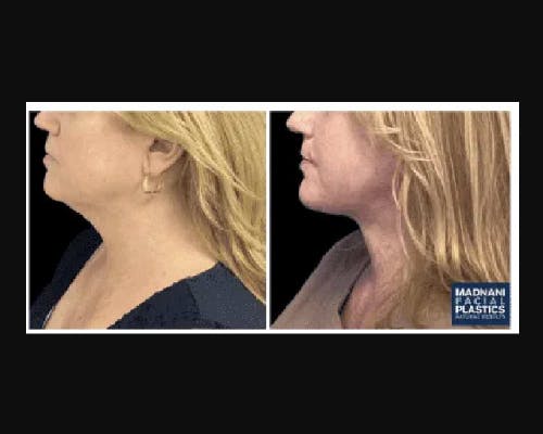 Deep Plane Facelift Before & After Gallery - Patient 268863 - Image 3