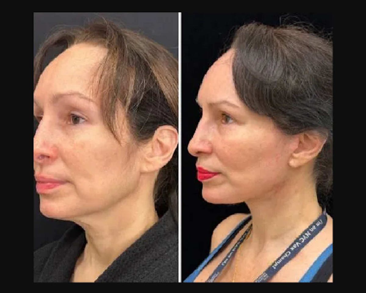 Deep Plane Facelift Before & After Gallery - Patient 677298 - Image 1