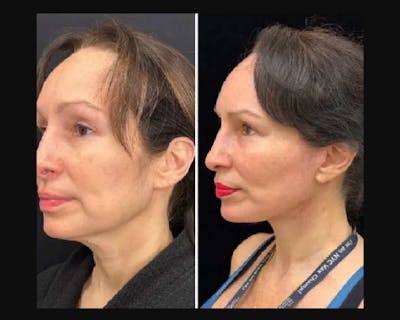 Deep Plane Facelift Before & After Gallery - Patient 677298 - Image 1