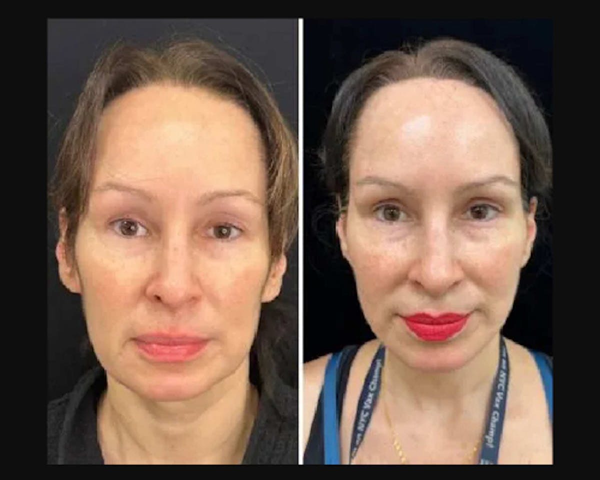 Deep Plane Facelift Before & After Gallery - Patient 677298 - Image 2