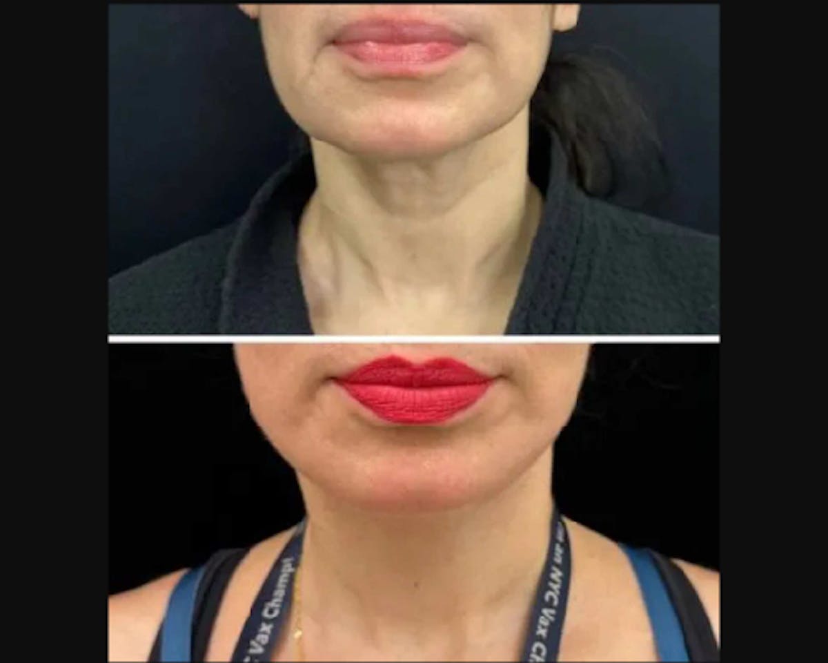 Deep Plane Facelift Before & After Gallery - Patient 677298 - Image 3