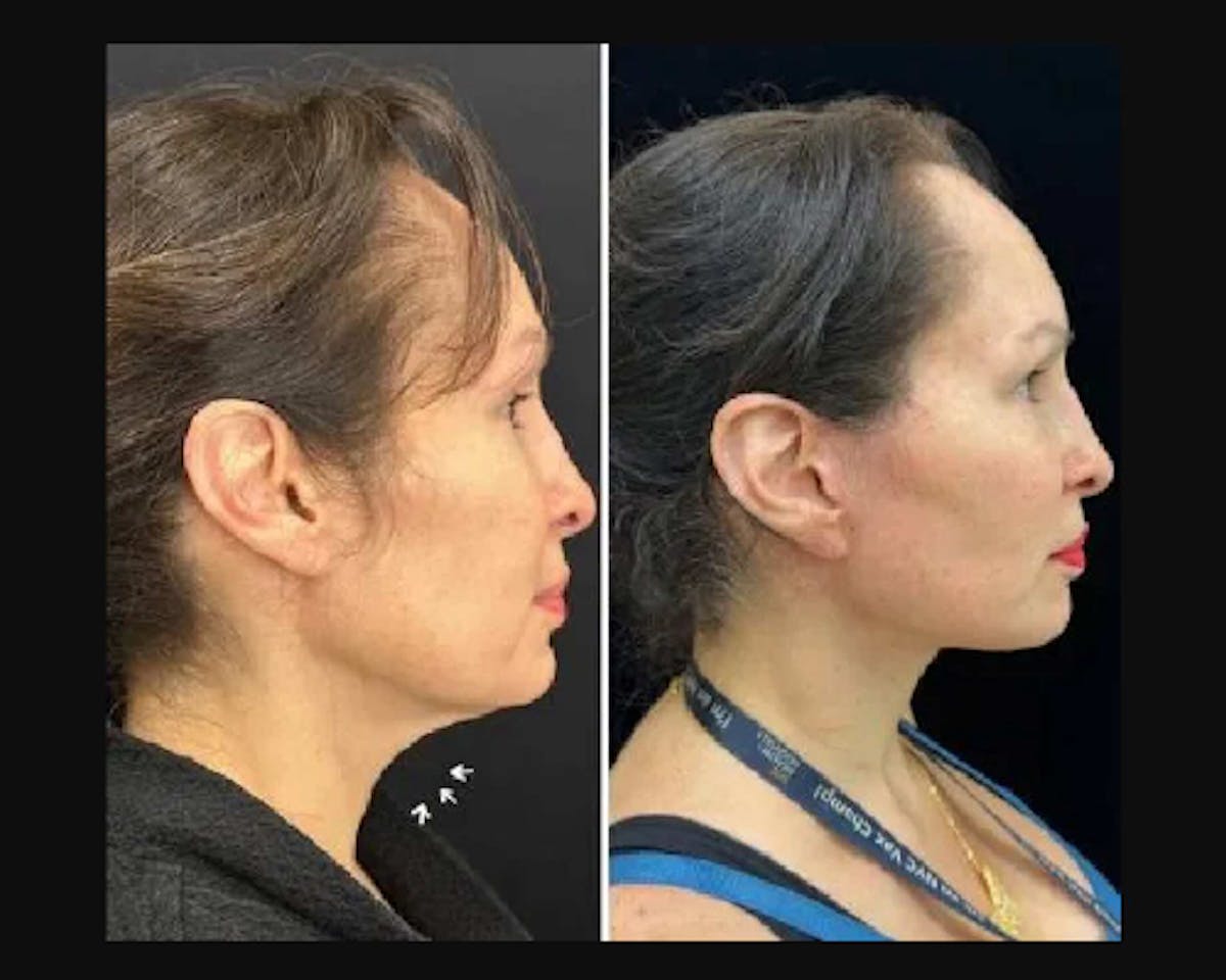 Deep Plane Facelift Before & After Gallery - Patient 677298 - Image 4
