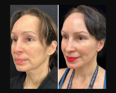 Deep Plane Facelift Before & After Gallery - Patient 677298 - Image 5