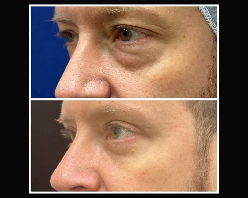 Lower Blepharoplasty Before & After Gallery - Patient 202492 - Image 3