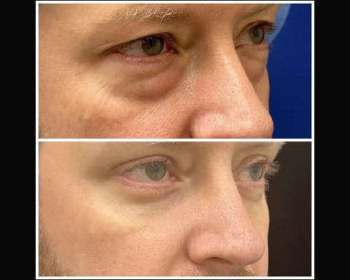 Lower Blepharoplasty Before & After Gallery - Patient 202492 - Image 4