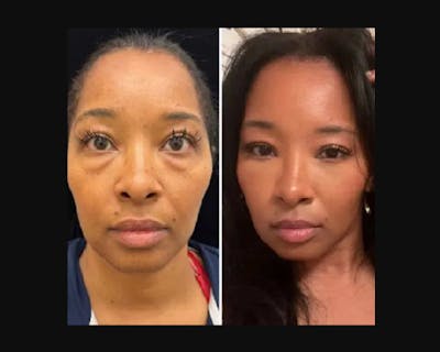 Lower Blepharoplasty Before & After Gallery - Patient 184397 - Image 1