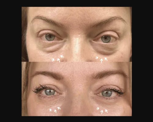 Lower Blepharoplasty Before & After Gallery - Patient 185526 - Image 1