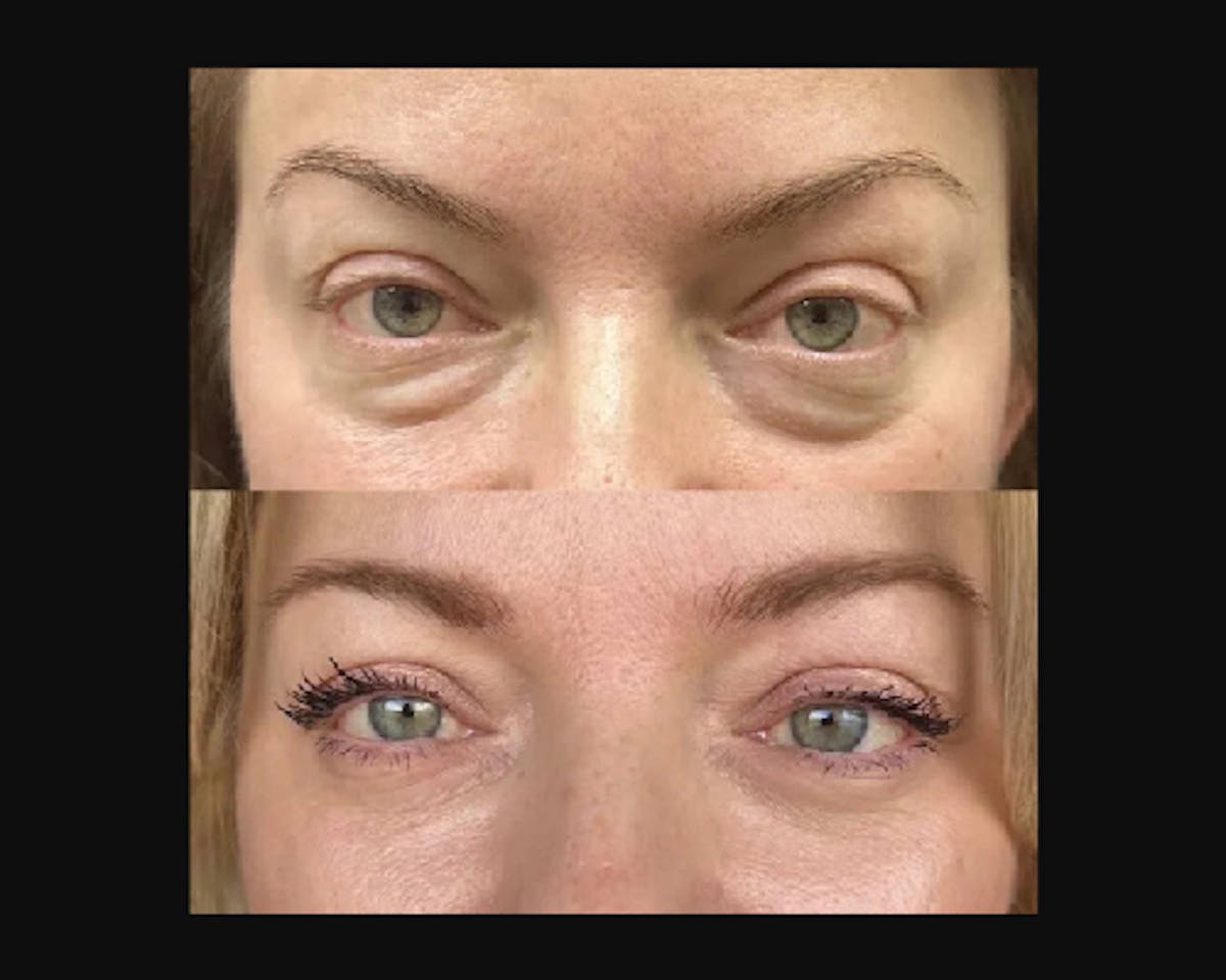 Lower Blepharoplasty Before & After Gallery - Patient 185526 - Image 2