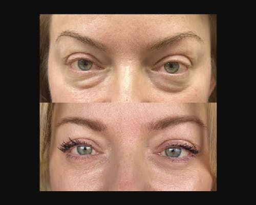 Lower Blepharoplasty Before & After Gallery - Patient 185526 - Image 2