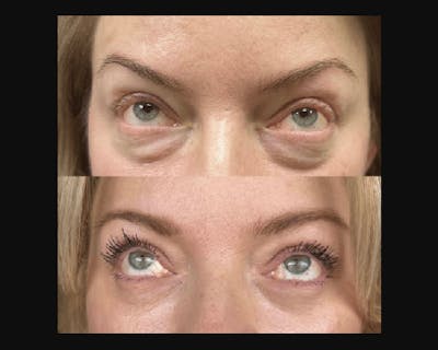 Lower Blepharoplasty Before & After Gallery - Patient 185526 - Image 3