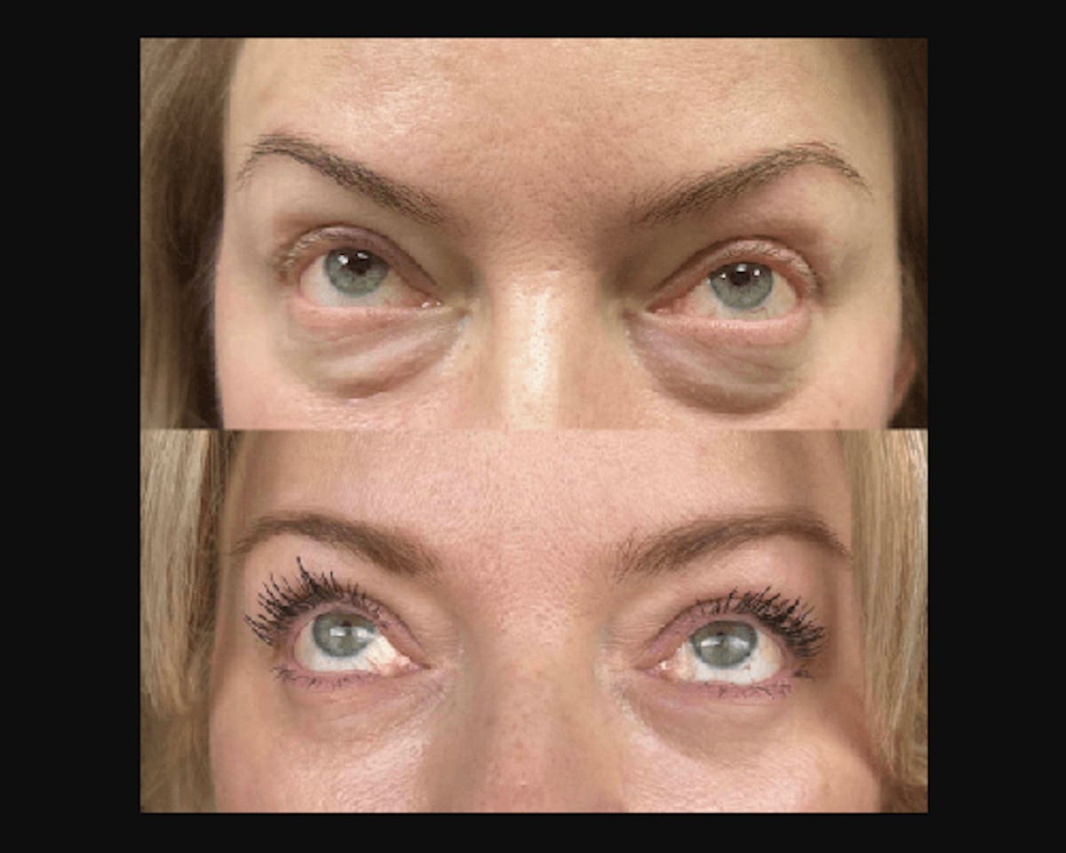 Lower Blepharoplasty Before & After Gallery - Patient 185526 - Image 4