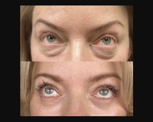 Lower Blepharoplasty Before & After Gallery - Patient 185526 - Image 4