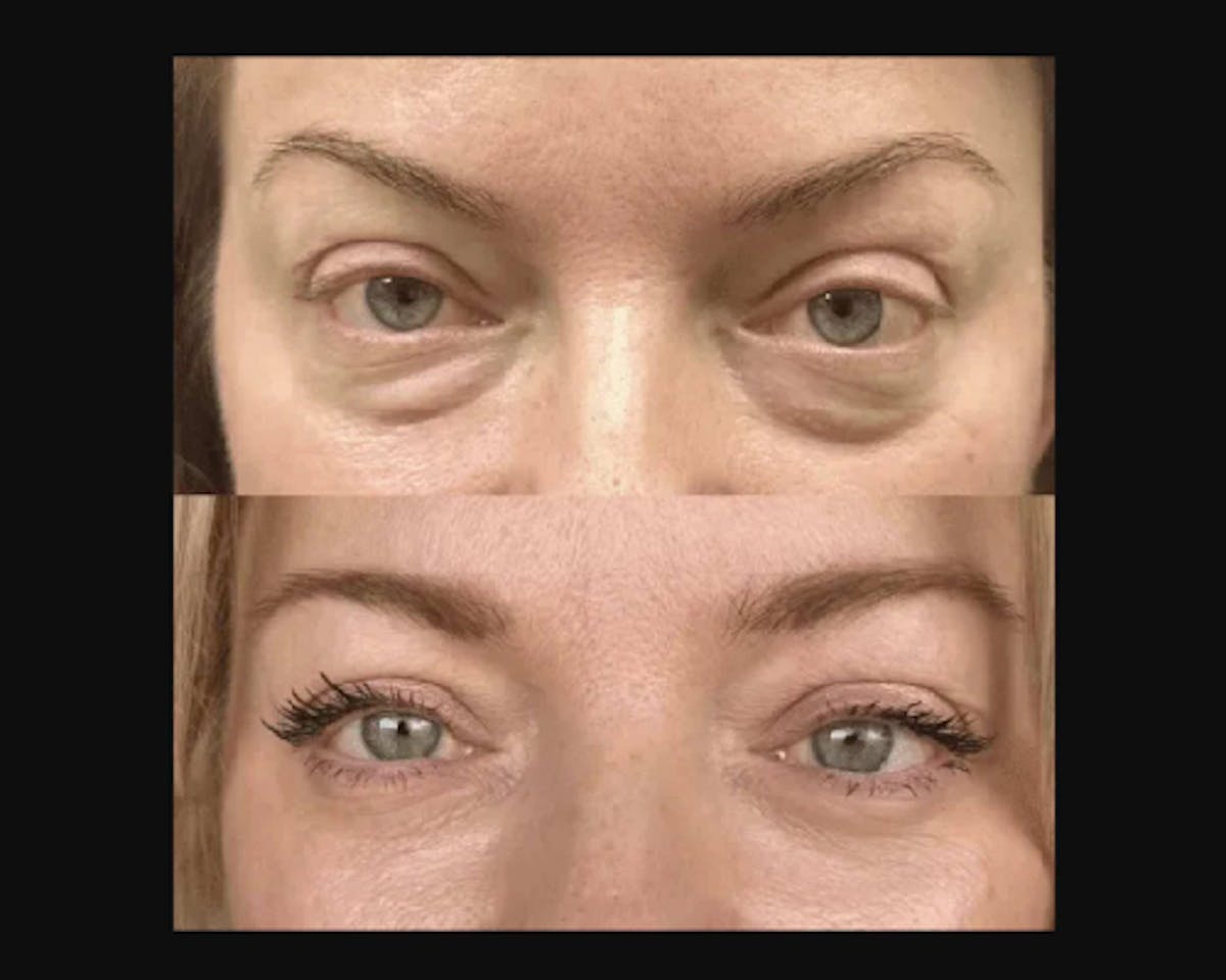 Lower Blepharoplasty Before & After Gallery - Patient 185526 - Image 5