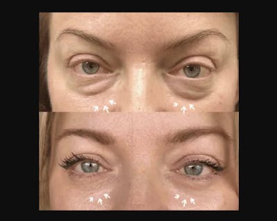 Lower Blepharoplasty Before & After Gallery - Patient 185526 - Image 6