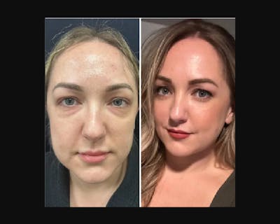 Lower Blepharoplasty Before & After Gallery - Patient 113928 - Image 1